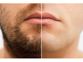 アウラ(AURA)/ヒゲ脱毛