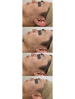 ジュエルオーキッド(Jewel orchids)/プラズマ