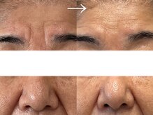 シェリー(cherie)/おでこのシワ、目元のしわ