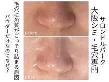 【毛穴エクストラクション】で長年の毛穴悩みを徹底改善！