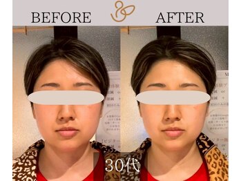 チョコバリ 新宿店(chocobari)/小顔×リフトアップ(美容鍼30代