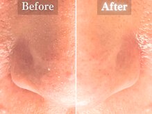 ボーンオム(Born Homme)/毛穴洗浄＋美容液導入：30代男性