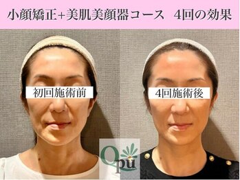 キュープ 福岡大牟田店(Qpu)/美顔器モニターコース4回の変化