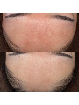 ベリスユイット(BELLIS HUIT)/【剥離なしハーブピーリング】