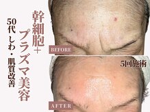 ベモーレ 谷町九丁目 上本町/50代プラズマ×幹細胞5回☆