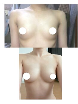 ワイサロン(Y salon)/バストアップ6ヶ月・D→Fカップ