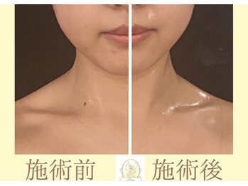 リコ(Rico)/1回でもフェイスラインスッキリ