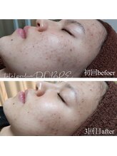 ドブレ(DOBRE)/【ニキビケア】