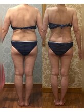 ヴィクトワール シュエット/【痩身】50代のお客様の変化！