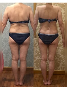 ヴィクトワール シュエット/【痩身】50代のお客様の変化！