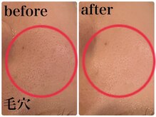 エヌインスキンケアスタジオ 天神店 N-inスキンケアスタジオ/症例【美肌/美白/小顔/毛穴】