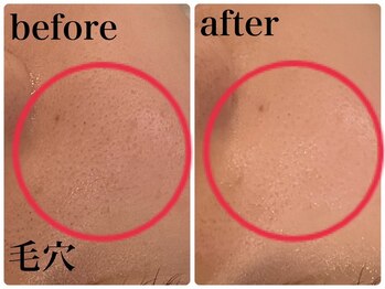 エヌインスキンケアスタジオ 天神店 N-inスキンケアスタジオ/症例【美肌/美白/小顔/毛穴】