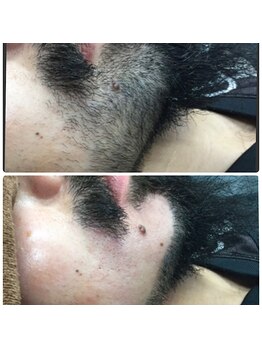 ハレノヒ(HaLeNoHi)/【ブラジリアンワックス】