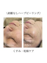 TD 一宮店/★お顔ハーブピーリング★