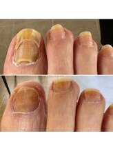 なかやまネイルクリニック/多重爪