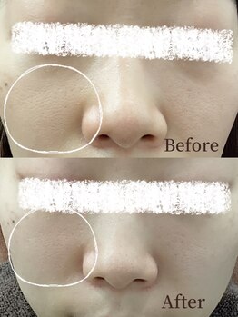 コスメティック雅/【毛穴開き改善】