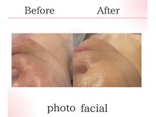 サロンツキ(salon tuki)/最新光フォト/症例/徳島