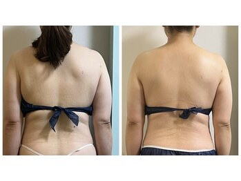 ピンクマジック(PINKMAGIC)/痩身コース（５回コースご利用）