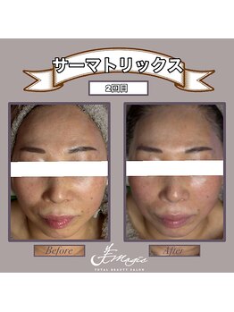 ビーマジック(美magic)/サーマトリックス