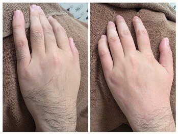 アンジェリーナ/ワックス脱毛/手の甲と指