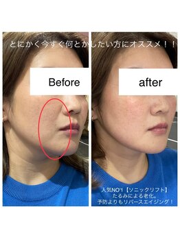 サロン ルイス アディクト(salon Lewis Addict)/ダントツ人気NO'1小顔リフト