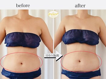 トレゾール(tresor)/★痩身★赤坂痩身エステ