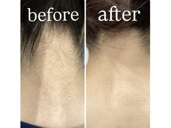 クラスペディア 嘉島店/うなじビフォー・アフター