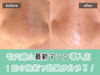 キザシ(kizashi)/最新毛穴ケア☆即実感！毛穴縮小