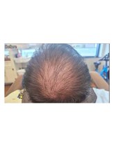 カブール 町田/抜け毛やM字が気になりだしたら