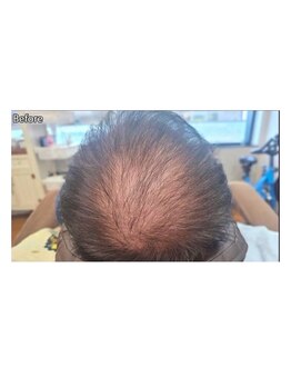 カブール 町田/抜け毛やM字が気になりだしたら