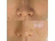 ミーン(miin)の雰囲気（セラピール◎直後にツルピカお肌に♪ニキビ毛穴あらゆるお悩みに）