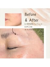 アンフィニ 麻布十番(Infini)/ヒト幹細胞フェイシャル