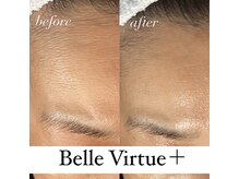 ベルバーチュプラス(Belle Virtue +)/カーボキシー