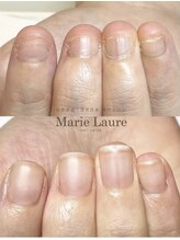 マリーロール 天王寺店(Marie Laure)/自爪育成/深爪矯正/ネイルケア
