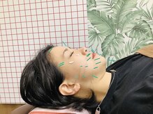 めいてる/美容ばり/リフトアップ/大阪市