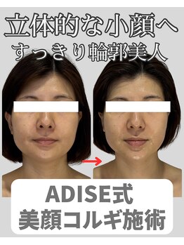 アディス 心斎橋(ADISE)/ADISE式コルギ！