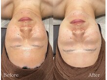 TD 鵜沼店/光フェイシャル