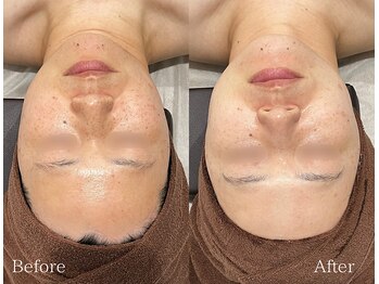 TD 鵜沼店/光フェイシャル