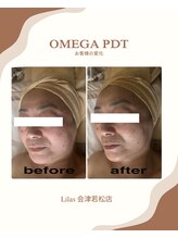 リラ(Lilas)/ララピール＆最新LED光で韓国肌