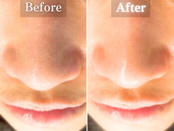 ボーンオム(Born Homme)/毛穴洗浄＋美容液導入：20代女性