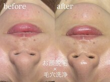 エーアール(ar)/お顔脱毛×毛穴洗浄