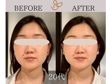 チョコバリ 新宿店(chocobari)/小顔×リフトアップ(美容鍼)20代