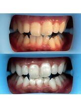 ホワイトニングセンター 富山二口店/富山　二口町ホワイトニング