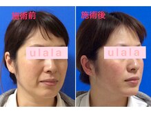 フェイシャルサロン うらら(ulala)の雰囲気（すぐに効果を実感できる定番造顔の【顔筋リフトマッサージ】）