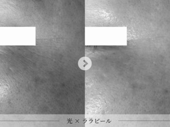 スパレーカ(Spa laka)/シミ・目尻のシワ