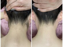 ニコ アンド キャンディー(Nico.&Candy)/うなじ脱毛　ビフォー＆アフター