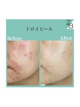 ザラハビューティー(ZARAHA Beauty)/トロイピール 　