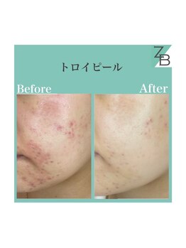 ザラハビューティー(ZARAHA Beauty)/トロイピール