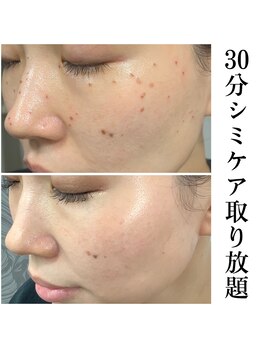 キビック(KIBIK)/【30分シミケアあて放題】