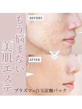 エヌ スタイル(N Style)/ハーブピーリング